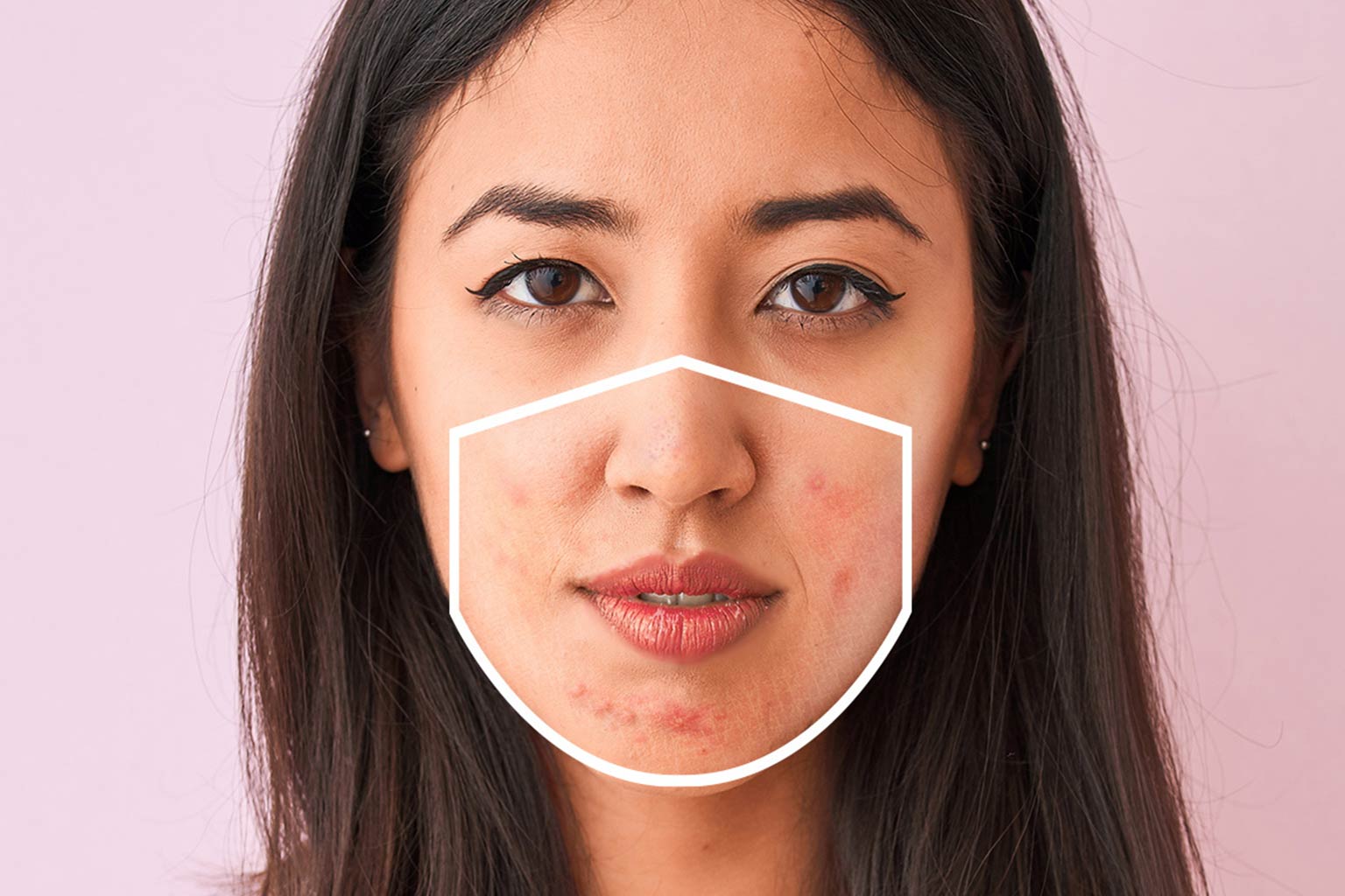 Maskne: Cosa consiglia l'esperto?