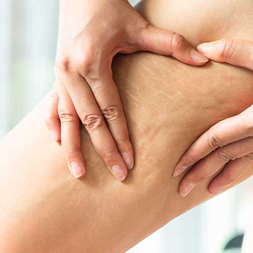 Anticellulite-smagliature-rassodanti